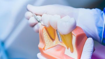 Implantate